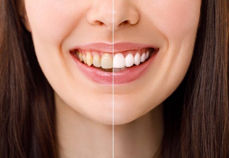 A close-up of whitening results shows sensitivity after teeth whitening in Springboro, OH